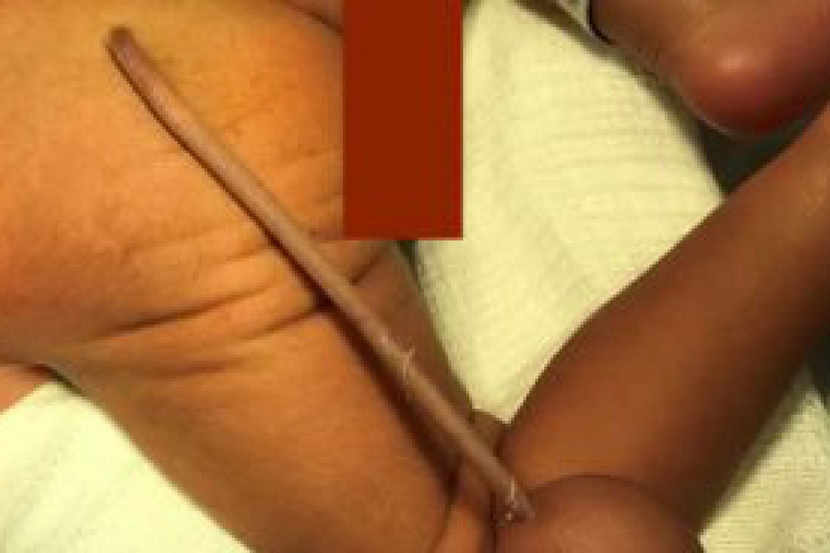 Brasil registra primeiro nascimento de bebê com cauda; entenda a anomalia