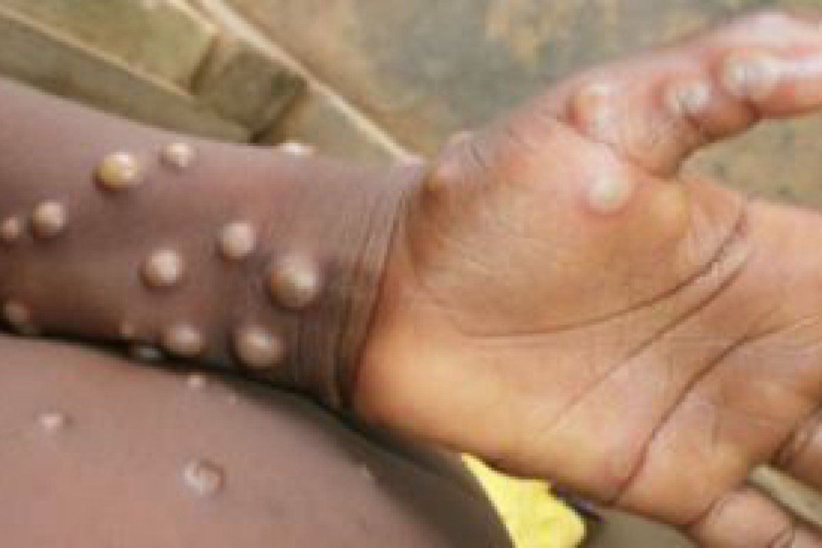 Ministério da Saúde confirma sétimo caso de varíola dos macacos no país